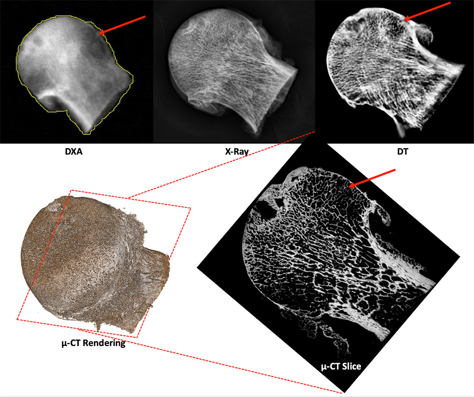 Quantification of Osteoporosis and Rheumatoid Arthritis